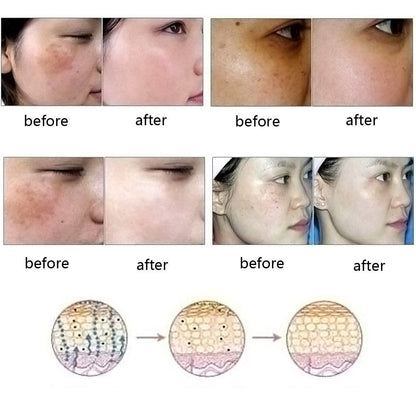 Natural Acne, Scar & Stretch Mark Removal Essence Oil – Herbal Skin Brightening & Regeneration Formula (10ml)