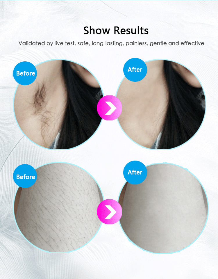 IPL Laser Hair Removal Device – At-Home Permanent Hair Reduction System