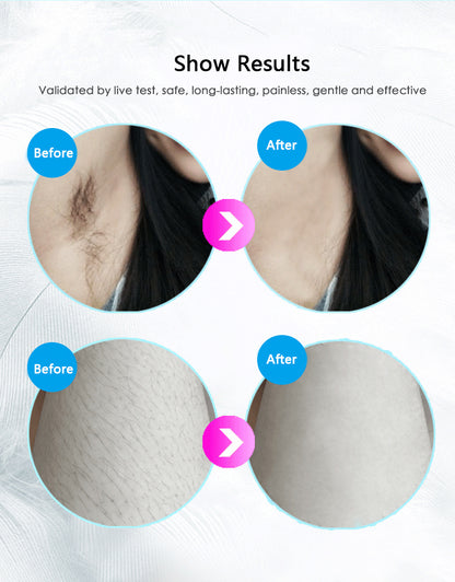 IPL Laser Hair Removal Device – At-Home Permanent Hair Reduction System